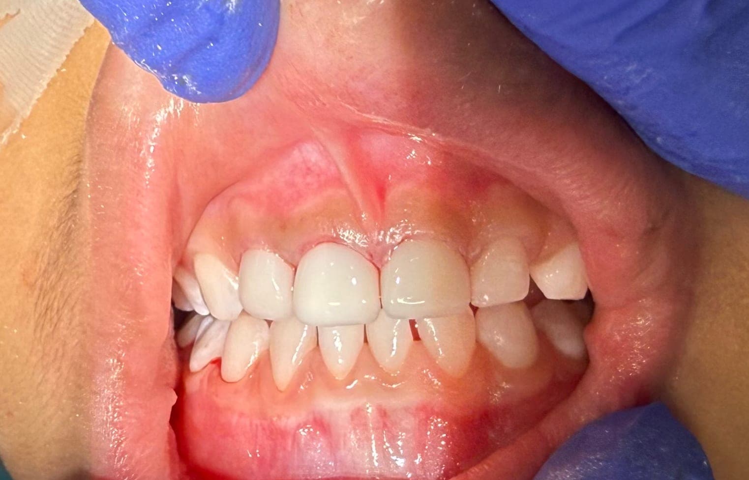 Immediate post-operative view of two seated zirconia central incisor crowns