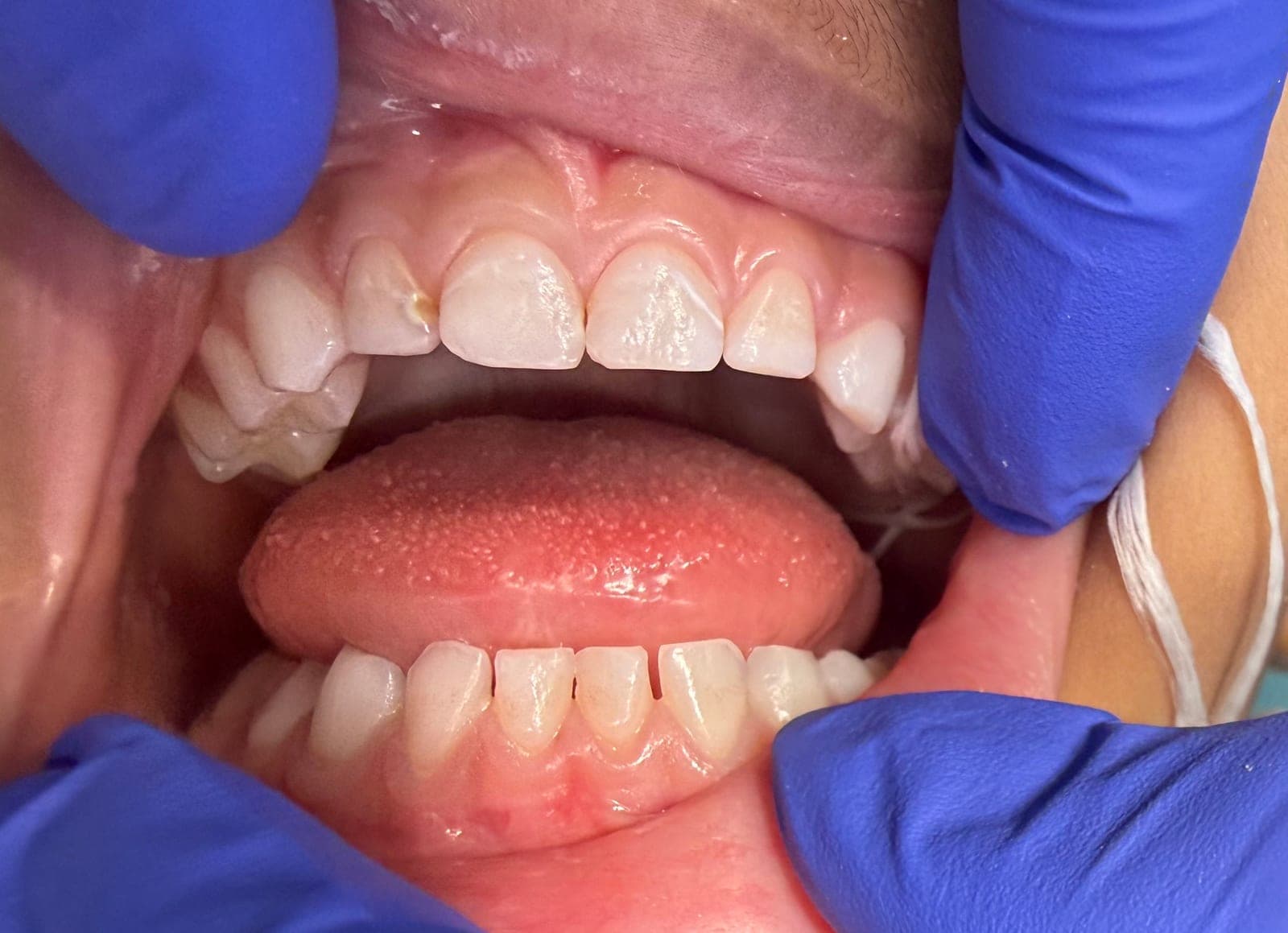 Pre-operative view of two maxillary primary central incisors with incisal wear and a lateral lesion