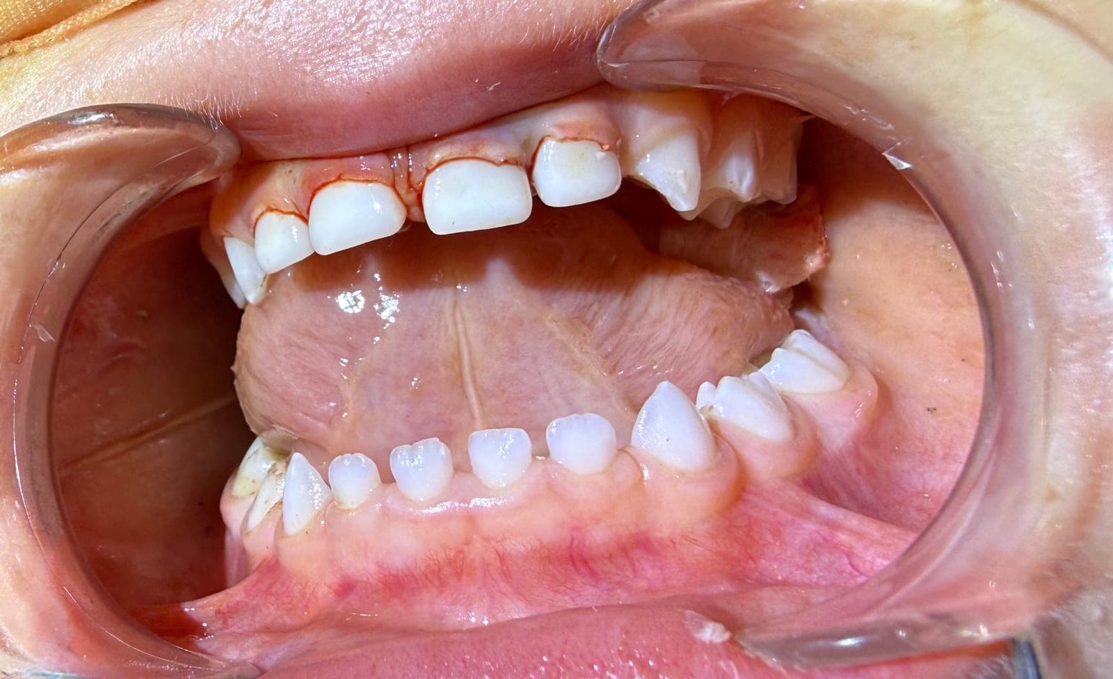 Immediate post-operative view of four seated zirconia incisor crowns with inflamed margins
