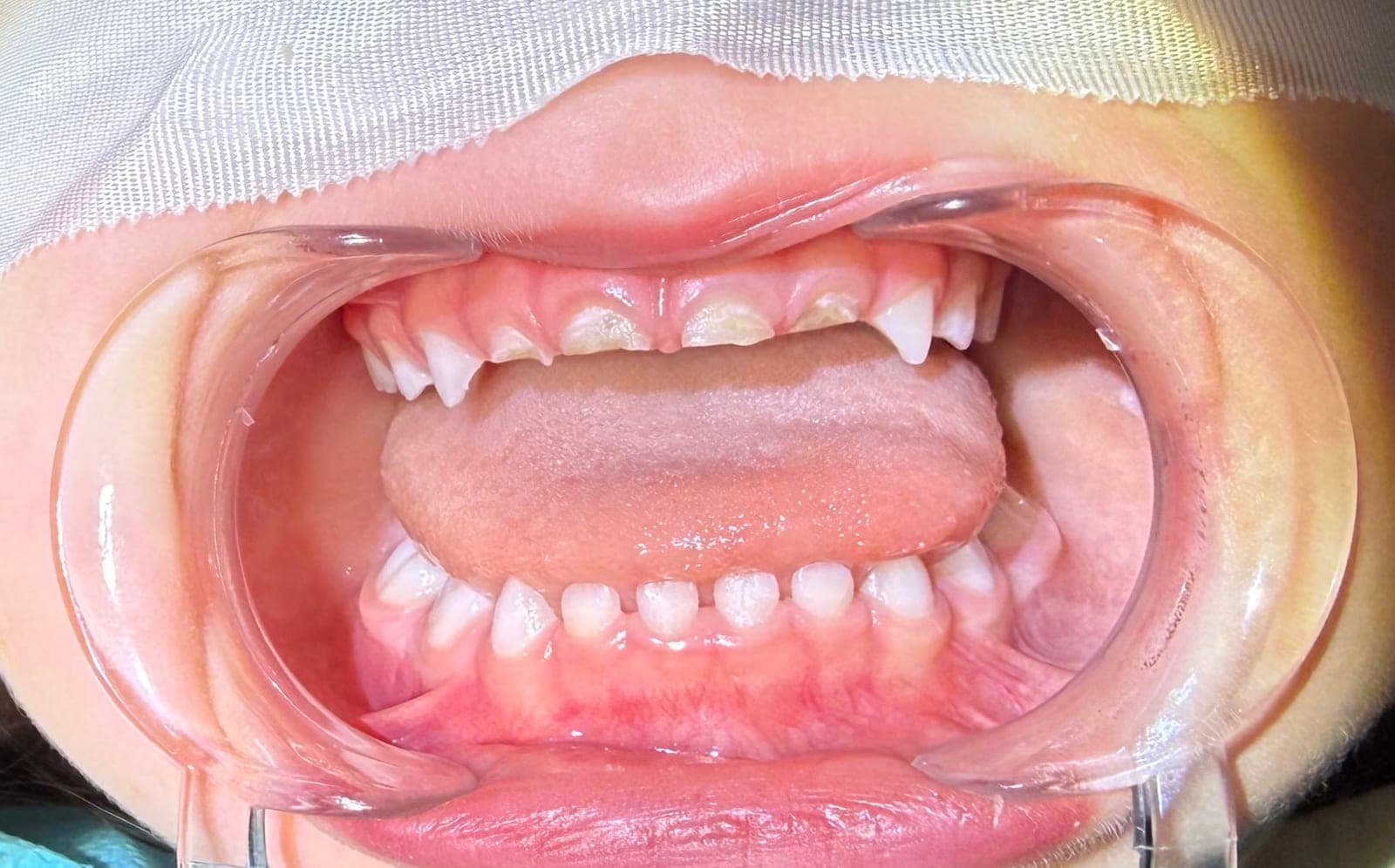 Pre-operative retracted view of maxillary primary incisors with gingival-third caries