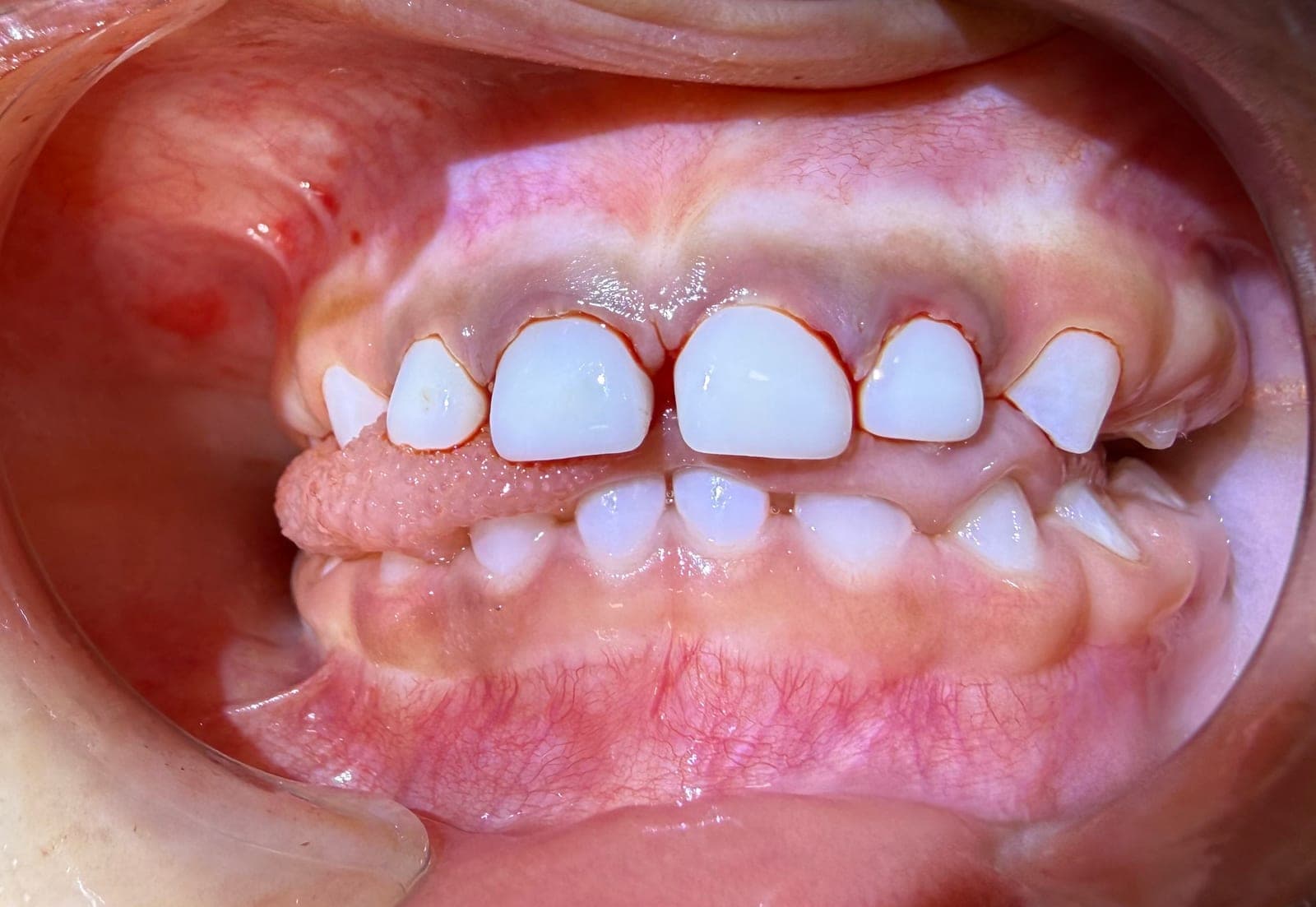 Immediate post-operative retracted view of four seated zirconia incisor crowns