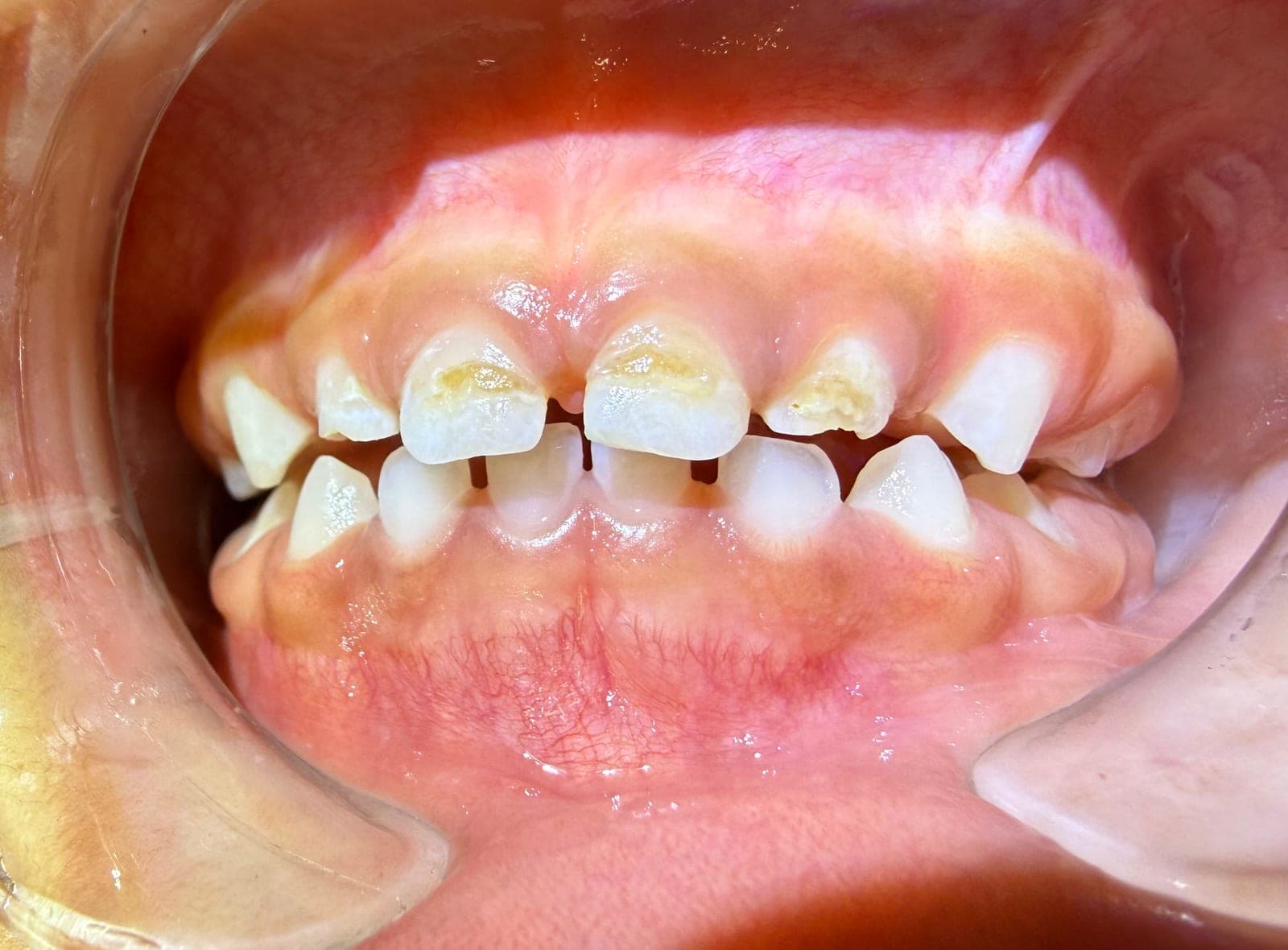 Pre-operative retracted view of four maxillary primary incisors with incisal and mesial caries