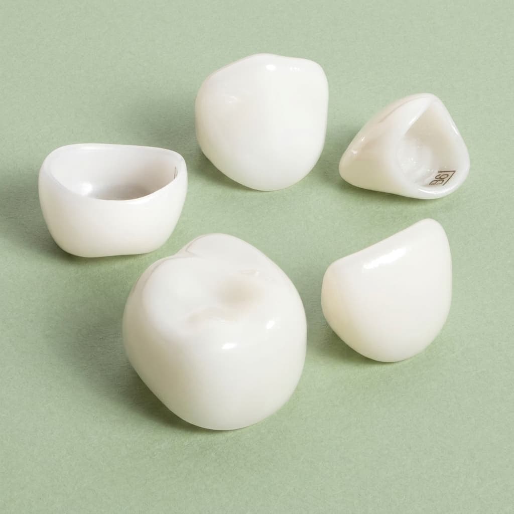 Mixed zirconia crowns, exterior and interior